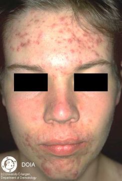 Acne vulgaris