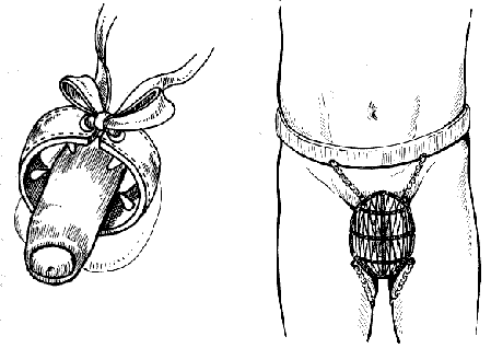 Фотография американских антимастурбационных приспособлений XIX в. для мальчиков
